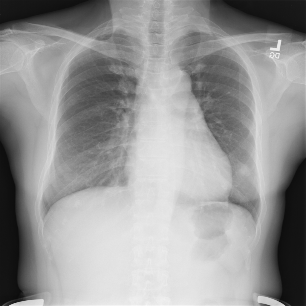 Chest X-ray from the NIH ChestX-ray14 dataset used by RadarMD